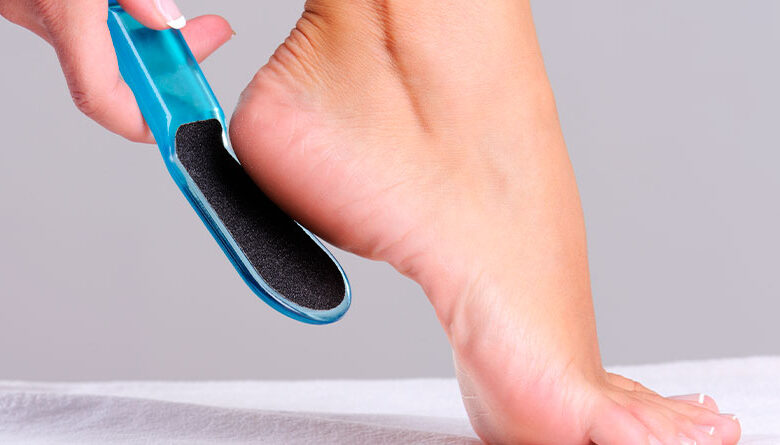 Como remover os calos dos pés de forma segura 